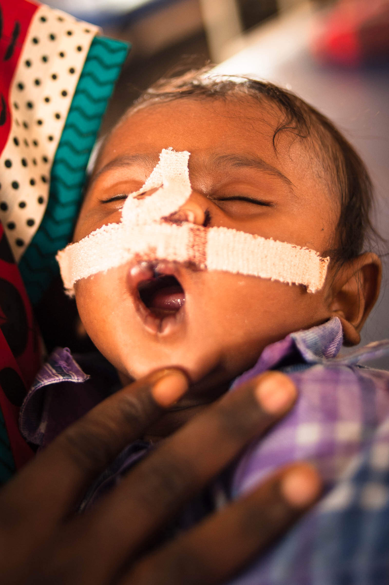Cleft Kind Indien 124