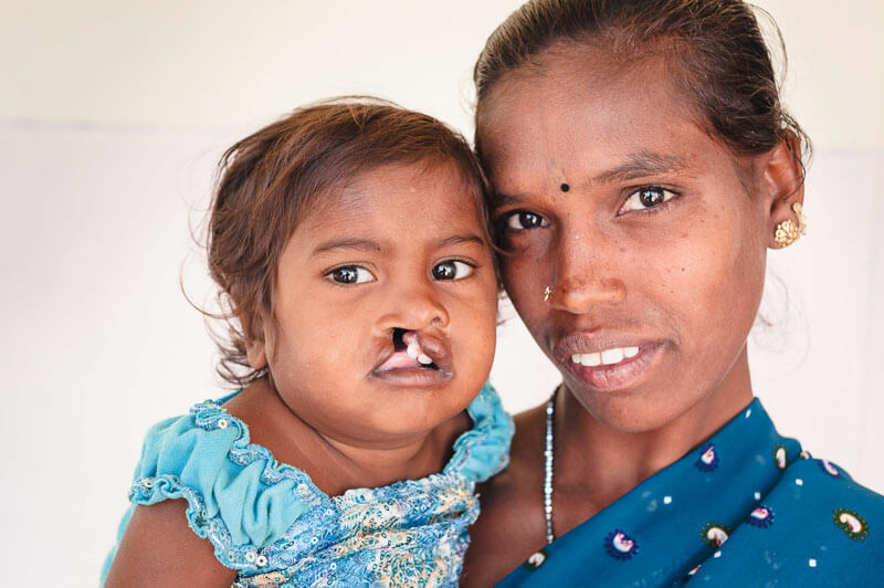 Cleft operation indien 5