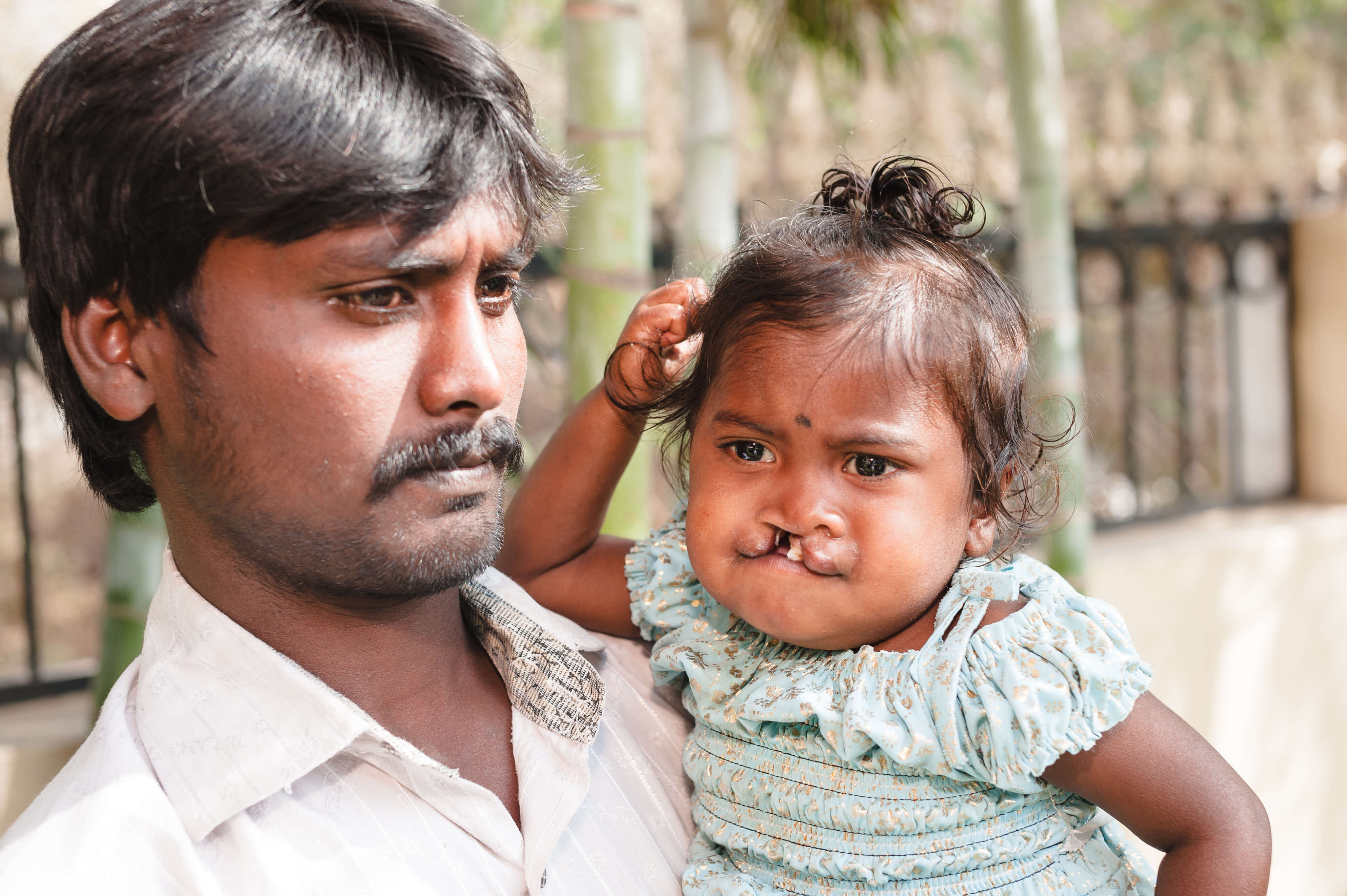 Cleft operation indien 6